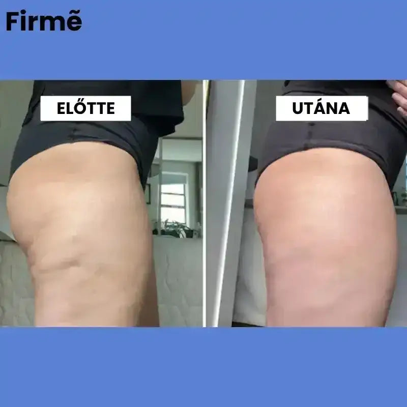 Firmé™ Cellulitkezelő Masszázsgép