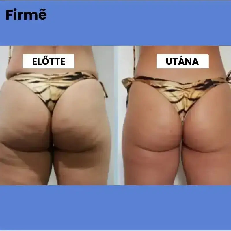 Firmé™ Cellulitkezelő Masszázsgép