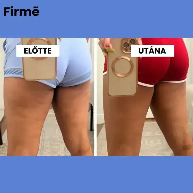 Firmé™ Cellulitkezelő Masszázsgép