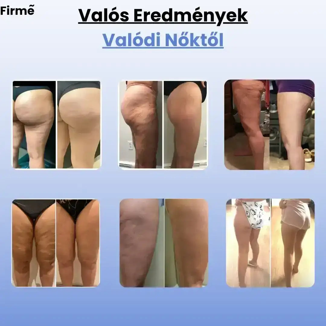 Firmé™ Cellulitkezelő Masszázsgép