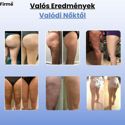 Firmé™ Cellulitkezelő Masszázsgép